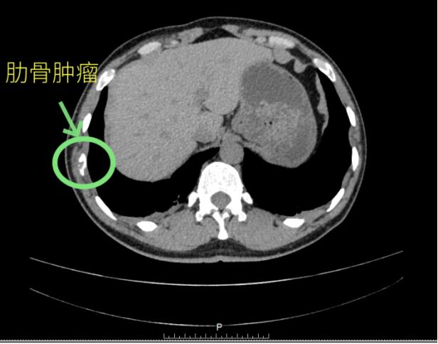 肋骨罕见病例368
